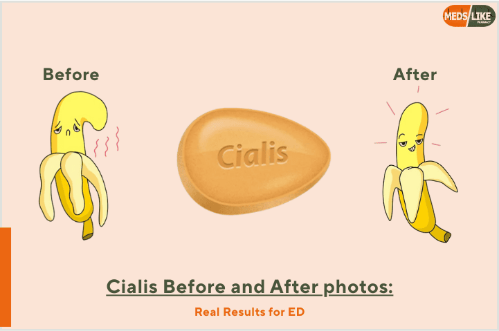 Cialis Before and After photos