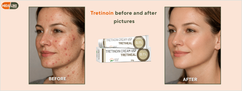 Tretinoin before and after pictures